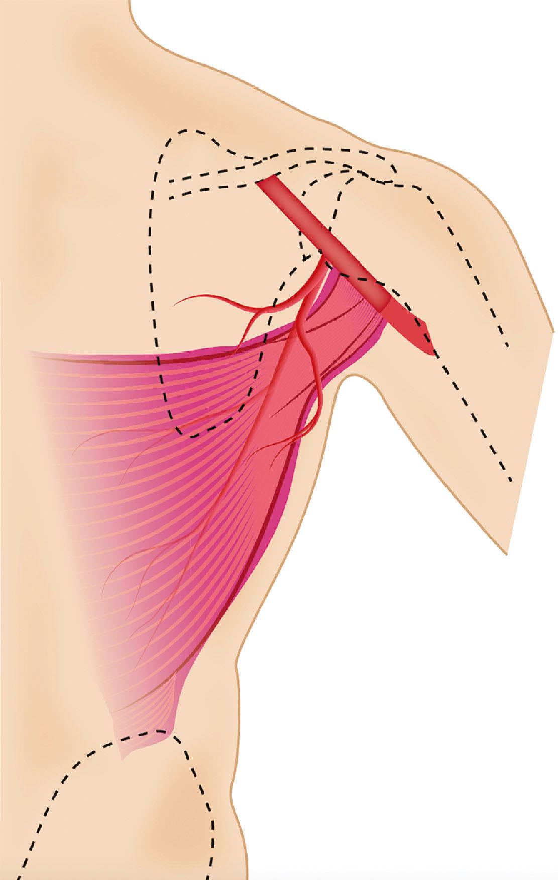 Figure 46.1, The anatomy of the thoracodorsal vessels. The main pedicle provides five branches, however, the vertical and the horizontal branches are the most developed. Perforators use arise from both branches. Anatomic studies showed the presence of 2–3 musculocutaneous perforators from the vertical branch. Direct (septal) perforator is found in 55% of the cases.