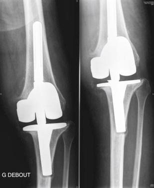 FIGURE 35.1, Case 1: Standard preoperative radiographs. A, Anteroposterior (AP) view. B, AP view centered on the tibial cortical defect