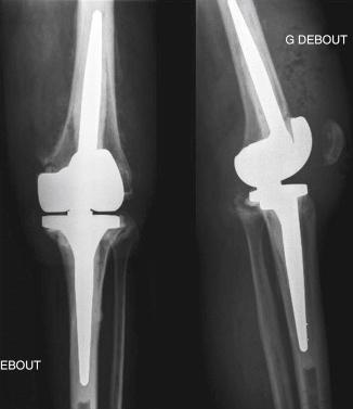 FIGURE 35.2, Case 1: Standard final radiographs. A, Anteroposterior view. B, Lateral view.