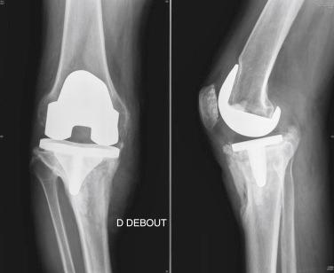 FIGURE 35.3, Case 2: Standard preoperative radiographs. A, Anteroposterior view. B, Lateral view.