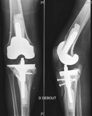 FIGURE 35.4, Case 2: Standard final radiographs. A, Anteroposterior view. B, Lateral view.