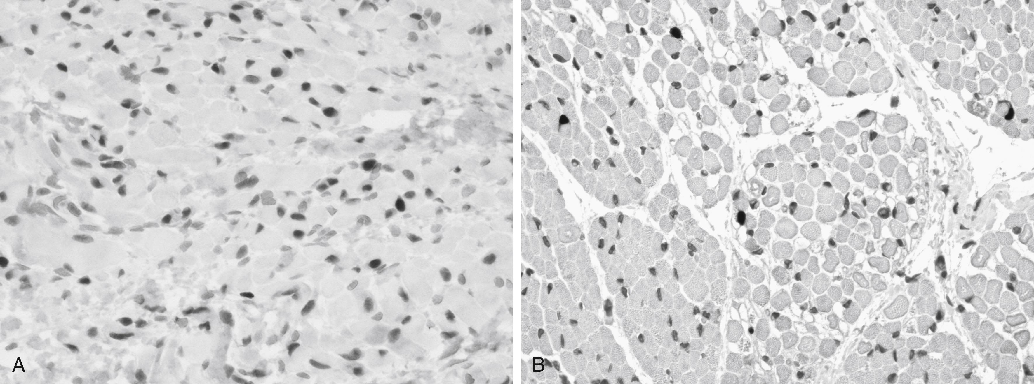 Fig. 138.1, Intranuclear myogenin immunoreactivity in (A) a term human neonate and (B) a 5-month-old boy with severe Duchenne muscular dystrophy. Normal neonatal muscle exhibits only occasional scattered nuclei that are marked; these are myoblasts or resident stem cells enclosed within the same basal lamina as their associated myofiber, also known as satellite cells in adult muscle. In muscular dystrophy, these myoblasts increase in number in an attempt to regenerate muscle; such extensive distribution as in this child resembles that of an 8- to 10-week fetus. (Original magnification ×250.)