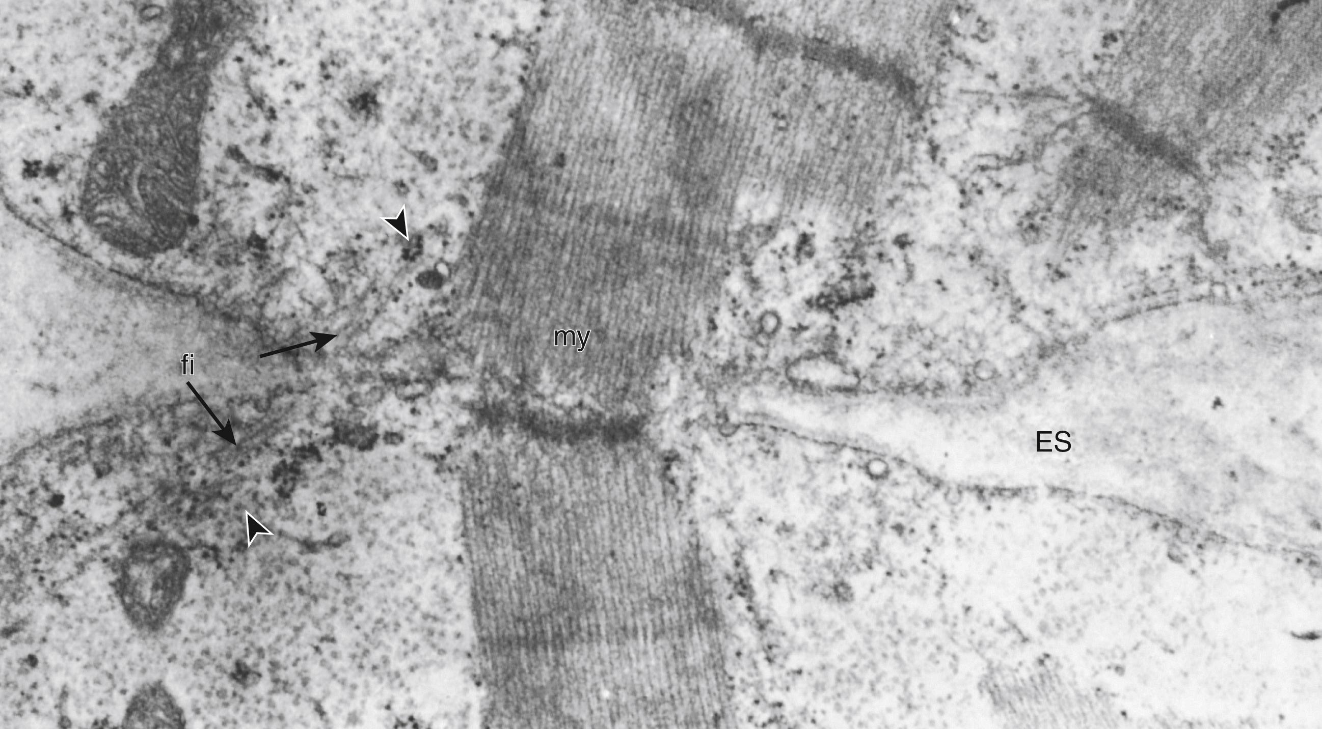 Fig. 138.3, Fusion of two myotubes, more advanced in development than the myocytes shown in Fig. 138.1 , from the soleus muscle of a 16- to 17-week fetus. A well-formed myofibril (my) extends between two cells, which are joined by a narrow channel of sarcoplasm. Polyribosomes (arrowheads) and unassembled filaments (fi) are present in both cells. ES, Extracellular space. (Original magnification ×19,500.)