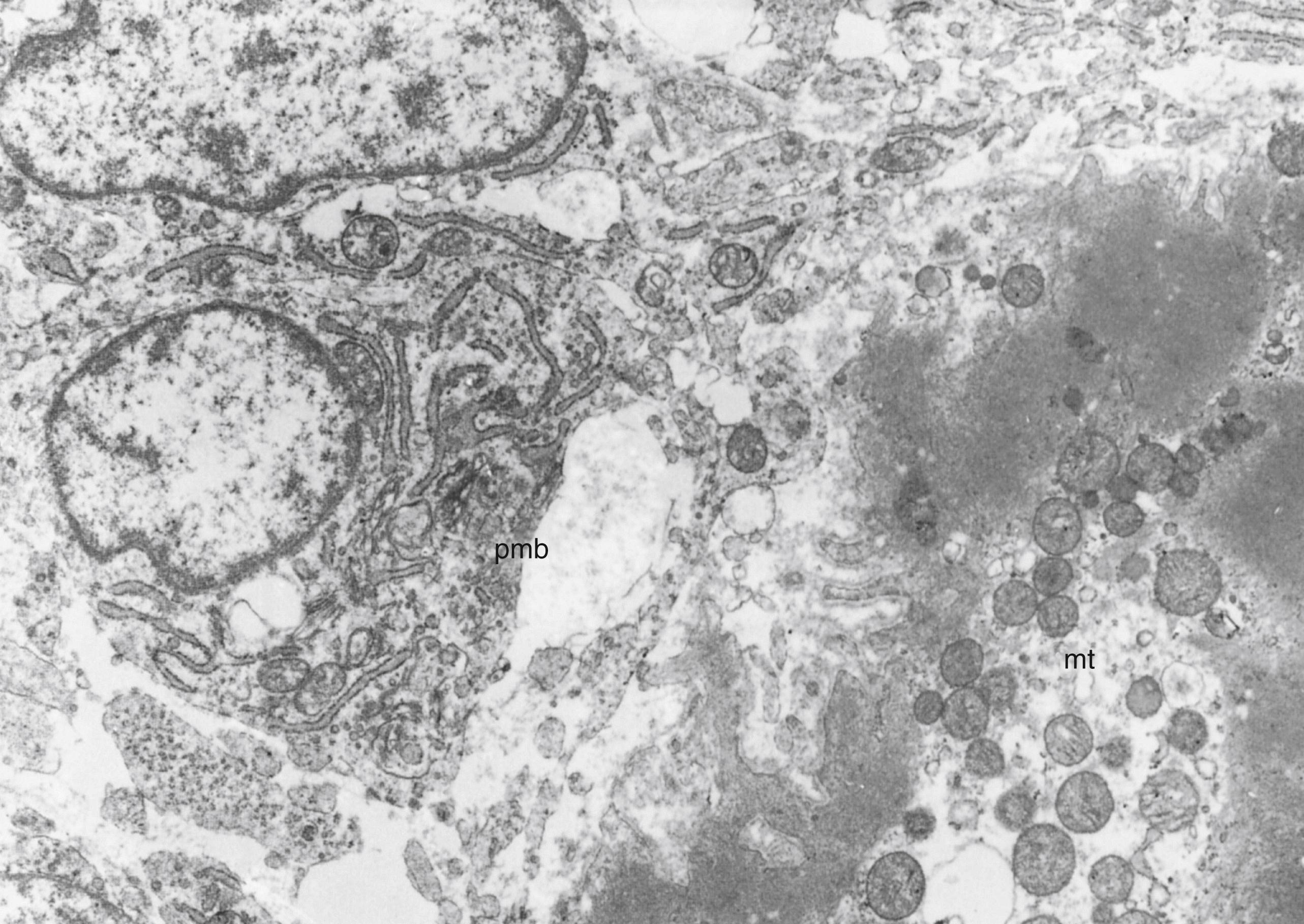 Fig. 138.4, Presumptive myoblast (pmb) associated with a myotube (mt) in the quadriceps femoris muscle of a 14-week human fetus. An extensive rough endoplasmic reticulum and many free ribosomes are present, but no contractile filaments or T tubules are developed. Mitochondria are also seen, both in the presumptive myoblast and in the central core of sarcoplasm of the adjacent myotube. (Electron micrograph, original magnification ×12,000.)