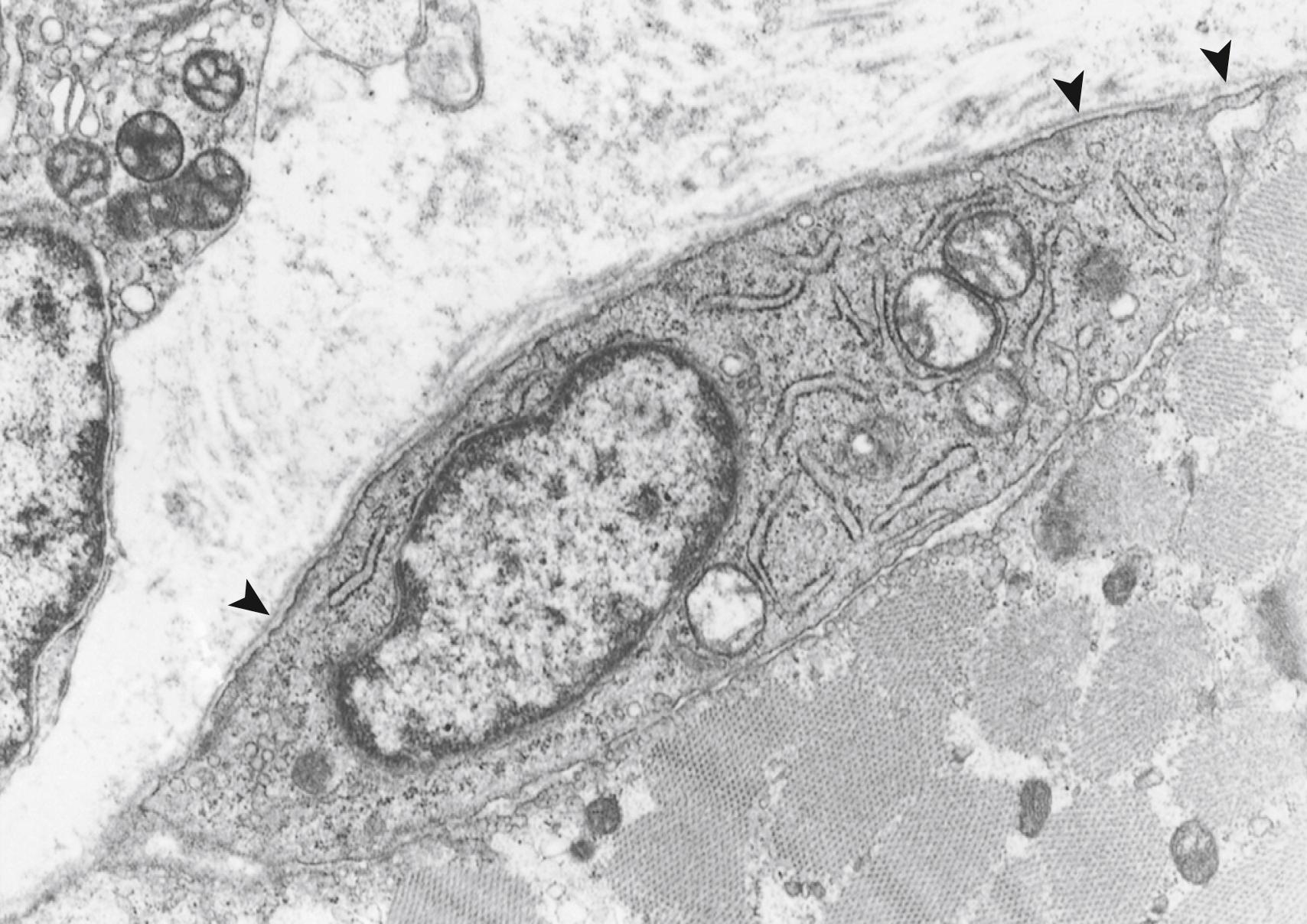 Fig. 138.5, Satellite cell of fully mature myofiber from quadriceps femoris muscle in a 7-year-old girl. As with the presumptive myoblast of fetal muscle (see Fig. 138.3 ), the satellite cell contains mitochondria, rough endoplasmic reticulum, and free ribosomes but no contractile proteins or T tubules and is enclosed within the same basal lamina (arrowheads) as the adjacent myofiber. The satellite cell is capable of mitosis and differentiation to become a true myoblast and then mature further and is the cell responsible for regeneration of injured muscle at any age. (Electron micrograph, uranyl acetate and lead citrate, original magnification ×20,000.)