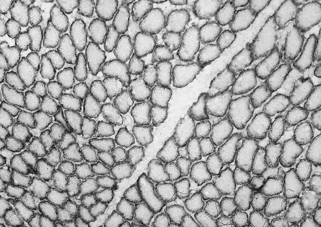 Fig. 138.6, Immunocytochemical stain demonstrating dystrophin outlining the sarcolemma of normal quadriceps femoris muscle fibers in a biopsy specimen of a term male neonate. The monoclonal antibodies shown are specific for the rod domain of the dystrophin molecule; other antibodies demonstrate only the carboxyl terminus or amino terminus. Dystrophin immunoreactivity is first detected in developing human muscle at 11 weeks gestation. (Original magnification ×250.)