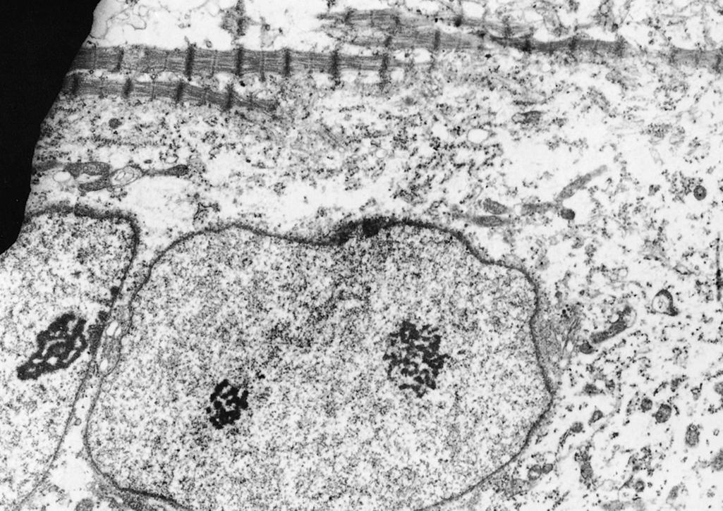 Fig. 138.8, Myotube in the quadriceps femoris muscle of a 14-week human fetus. Nuclei exhibit finely dispersed chromatin and strands of ribonucleoprotein-forming nucleoli. Newly formed sarcomeres of contractile proteins are seen at the top. The sarcoplasmic core contains many mitochondria. (Electron micrograph, uranyl acetate and lead citrate, original magnification ×10,000.)