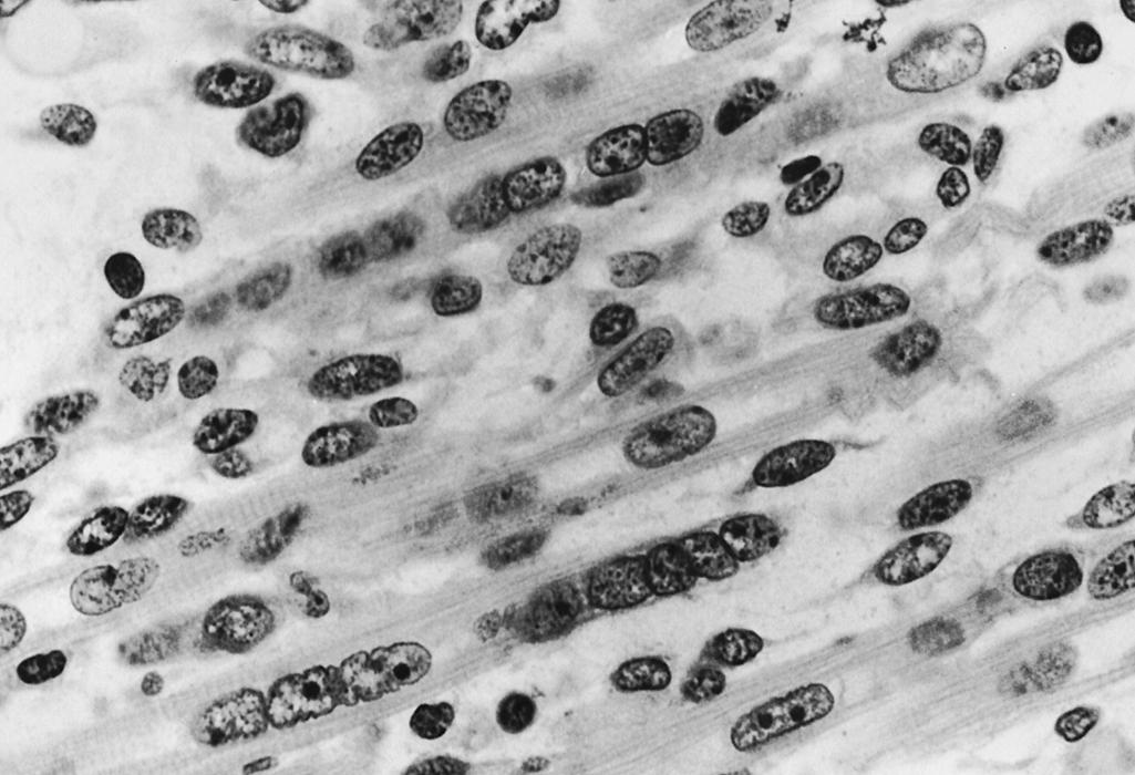 Fig. 138.10, Myotubes in the quadriceps femoris muscle of a 12-week human fetus. The spacing of central nuclei is variable. Rows of closely spaced, contiguous nuclei without intervening sarcoplasm are seen, or segments of internuclear sarcoplasm, often several nuclear diameters in length, are found. (Hematoxylin and eosin, original magnification ×1000.)