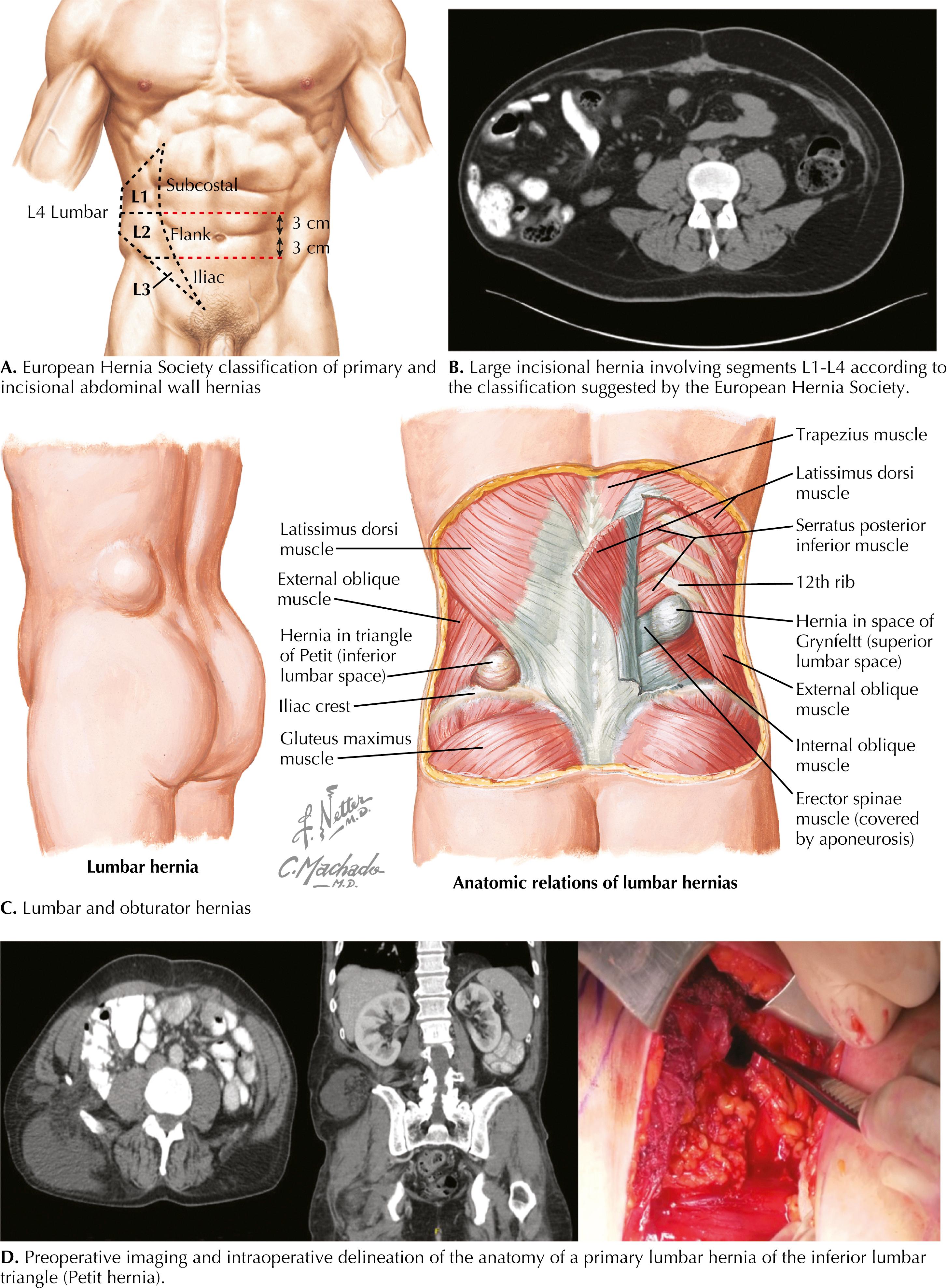 FIGURE 39.1, Anatomy and classifications of flank and lumbar hernias.