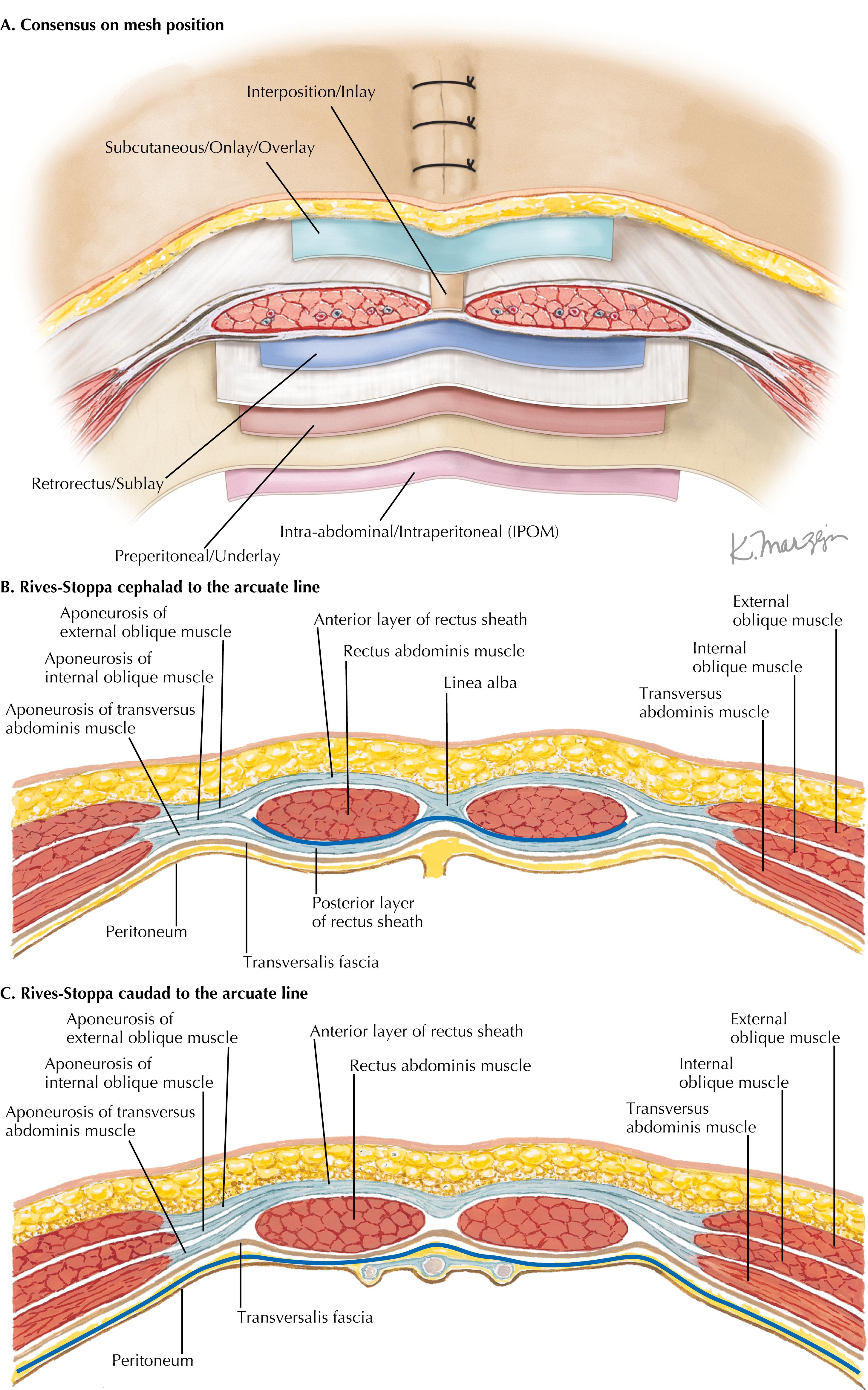 FIGURE 40.1, Retromuscular mesh placement and Rives-Stoppa cephalad and caudad arcuate lines.