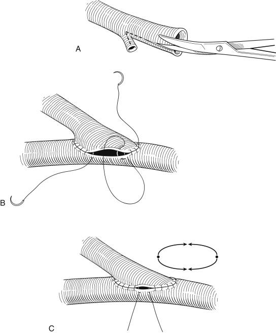 Figure 44-1, A, A vein tributary is incorporated into the venotomy to create a wider and slightly elevated anastomosis. This help prevents stenosis at heel of the graft. B, The first suture typically begins at the heel. The sutures are sewn continuously to a point halfway along the anastomosis, and then the second suture is started at the toe and sewn to the first suture. C, The two sutures are sewn continuously toward each other. The use of two separate sutures ensures symmetry and prevents “purse stringing,” as noted in the circular schematic.