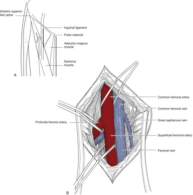 Figure 44-2, A, The femoral triangle is bordered by the inguinal ligament and the adductor magnus and sartorius muscles. The dashed line is the proposed skin incision for exposure of the common femoral artery and proximal superficial fermoral artery and profunda femoris artery. B, The common femoral artery lies laterally to the common femoral vein. The profunda femoris artery exits posterolaterally. The great saphenous vein enters anteromedially.