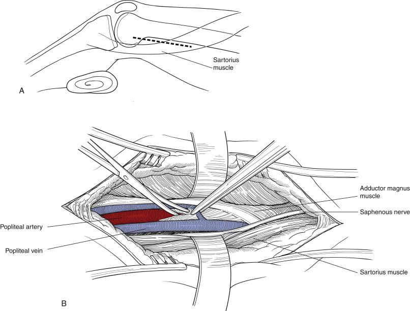 Figure 44-3, A, The dashed line anterior to the sartorius muscle marks the skin incision for exposure of the above-knee popliteal artery. Placing a stack of towels beneath the knee facilitates this exposure. B, The above-knee popliteal artery is seen exiting the adductor magnus tendon (Hunter canal). The popliteal artery is encased in a fibrous sheath and closely surrounded by paired popliteal veins.