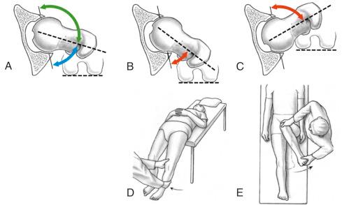 Fig. 54.1, Normal range of motion (A), decreased external rotation (B), and decreased internal rotation (C) are shown schematically. The posterior impingement test (D) is performed in extension and external rotation. Typically, external rotation in extension is decreased if the test is positive (painful). The anterior impingement test (E) is performed with internal rotation in 90 degrees of flexion.