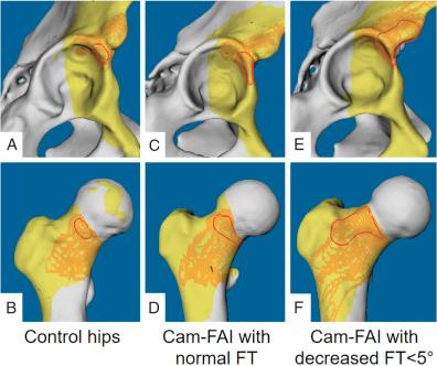 Fig. 54.2, Anterior extraarticular subspine femoroacetabular impingement (FAI) is shown in a patient with low femoral torsion (FT) in 90 degrees of flexion and 30 degrees of internal rotation with 20 degrees of adduction for a control hip (A and B), for cam-type hip with normal FT (C and D) and for a hip with decreased FT (E and F). Impingement zones are marked by red.