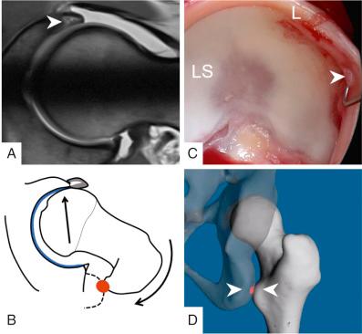 Fig. 54.3, Anterior acetabular labrum damage (arrowhead) is shown in preoperative magnetic resonance arthrography (A) and intraoperative view (B) during surgical hip dislocation with corresponding labral lesion (arrowhead) . Posterior extraarticular ischiofemoral impingement can potentially lead to levering out or subluxation of the femoral head (C) due to the osseous conflict between the lesser trochanter and the ischial tuberosity as visualized with 3-dimensional computed tomography–based impingement simulation (D). LS, Lunate surface; L, acetabular labrum.