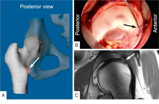 Fig. 54.4, Posterior extraarticular ischiofemoral femoroacetabular impingement is shown using computed tomography–based 3-dimensional reconstruction of the pelvis and proximal femur and simulation of hip impingement (A). Impingement occurs at hip extension and external rotation ( arrow ). Anterior labral lesion ( arrow ) corresponding to the levering out mechanism is shown (B and C).