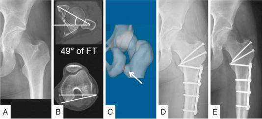 Fig. 54.5, Anteroposterior radiograph (A) and computed tomography (CT) scan (B) of a 25-year-old female patient is shown. A high femoral torsion (FT) is present. (C) CT-based 3-dimensional reconstruction and simulation of hip impingement showed a posterior extraarticular ischiofemoral hip impingement (arrow) . She underwent femoral derotational osteotomy (D and E) to decrease femoral torsion. Three years postoperatively, she is pain free.