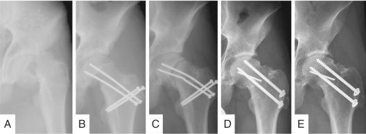 Fig. 54.6, Anteroposterior radiographs of a 13-year-old male patient with severe slipped capital femoral epiphysis are shown (A). He underwent the modified Dunn procedure (B) and revision osteosynthesis after breakage of the K-wires (C and D). At 10-year followup, he had a preserved hip joint with no hip pain and no progression of osteoarthritis (E).