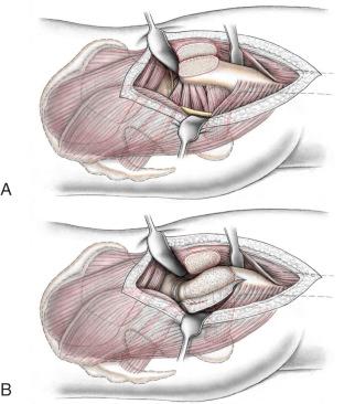 Fig. 54.7, The original technique of surgical hip dislocation combined with a sliding trochanteric osteotomy is shown (A). The development of an extended retinacular soft tissue flap is shown (B). The step-cut trochanteric osteotomy is shown in (C) and (D).