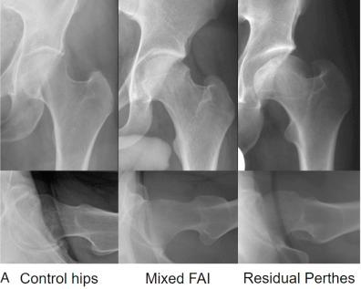 Fig. 54.8, (A–D) Residual Perthes deformity is shown using computed tomography–based 3-dimensional reconstruction of the pelvis and proximal femur and simulation of hip impingement. Impingement zones are marked by red. FAI, femoroacetabular impingement.