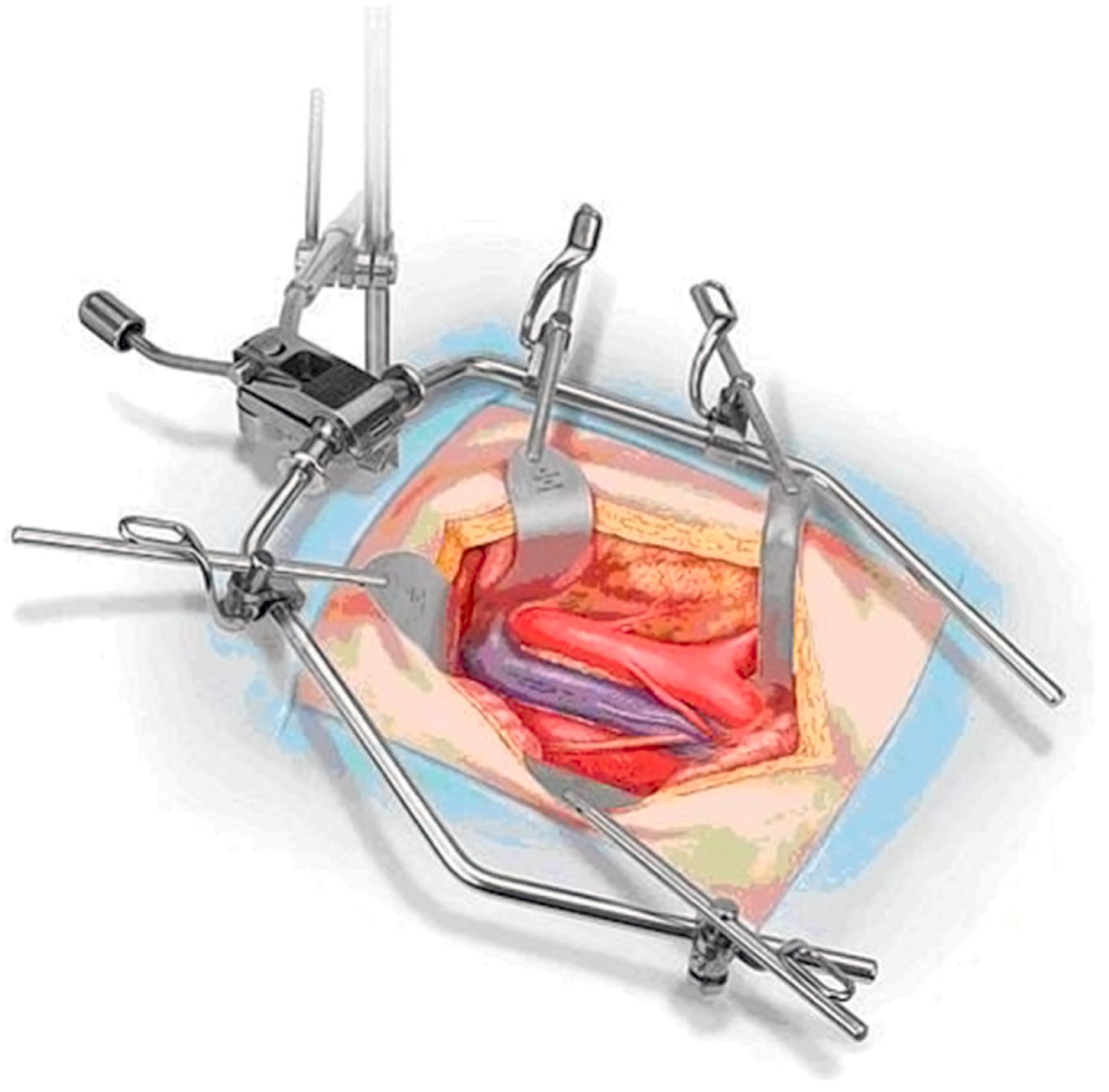 eFigure 61.20, Omni-Tract retractor.