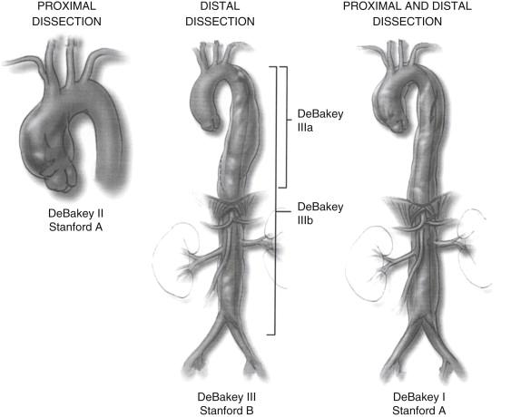 FIGURE 1, Aortic dissection is classified on the basis of the involvement of the proximal aorta, the distal aorta, or both. For comparison, both commonly used classification schemas are included.