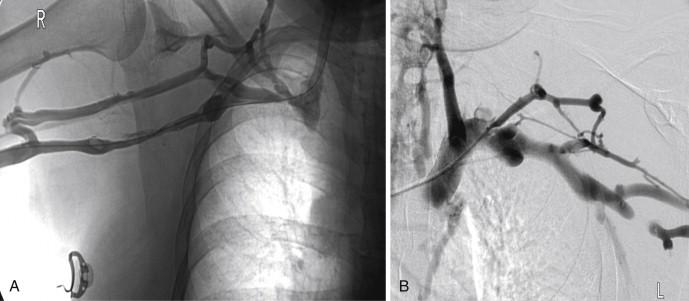 FIGURE 1, Bilateral upper extremity contrast venography in a patient with superior vena cava syndrome confirms patency of both left and right subclavian veins but occlusion of the right innominate vein (A) and most of the left innominate vein (B).