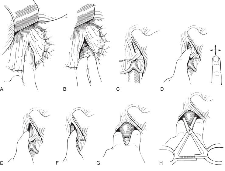 FIG 43.1, (A–H) Technique for occluding the supraceliac aorta without visualization of the structures dissected.