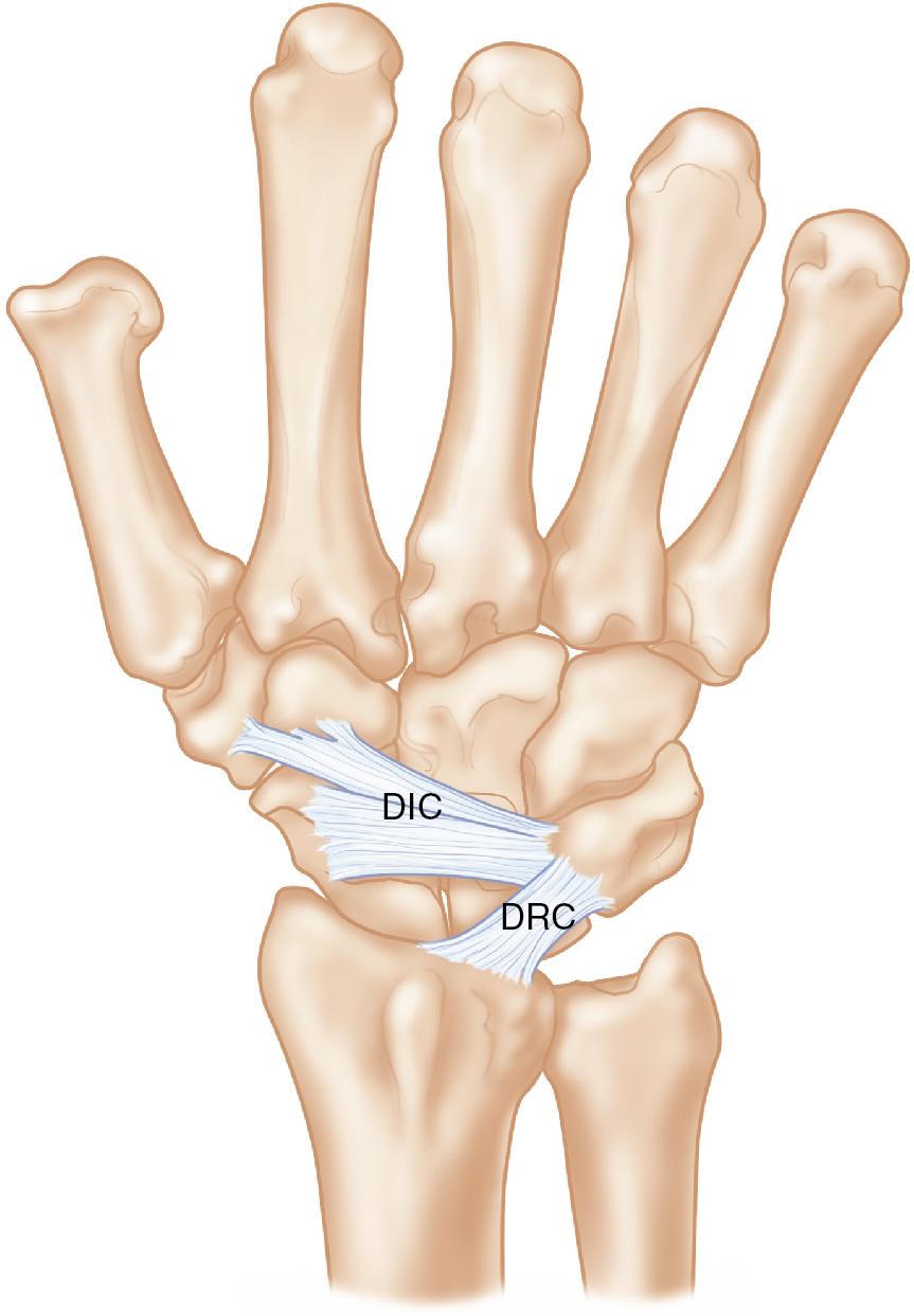 FIGURE 28.4, DIC , Dorsal intercarpal ligament; DRC , dorsal radiocarpal ligament.