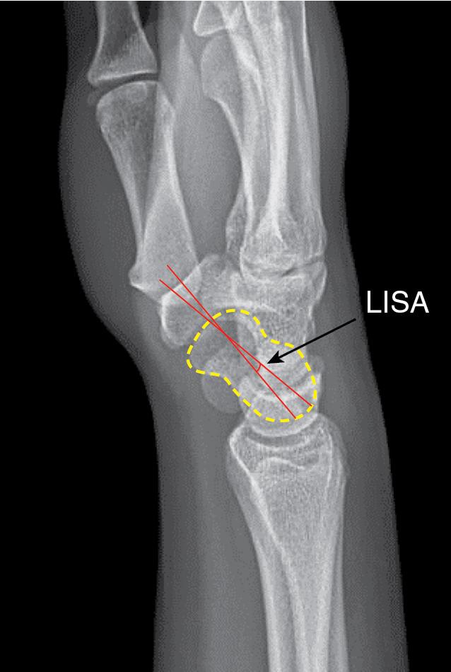 FIGURE 25.3, Lateral intrascaphoid angle (LISA).