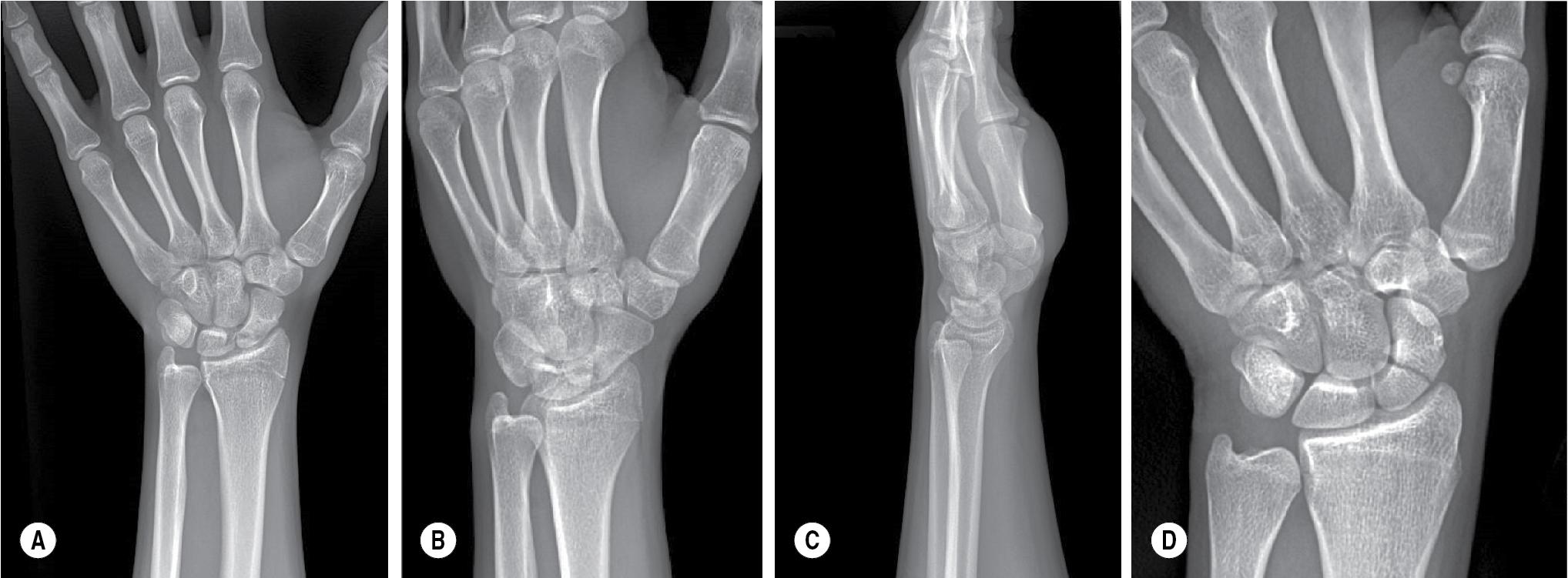 FIGURE 25.7, Radiographs demonstrating a fracture of the scaphoid waist: (A) posteroanterior [PA], (B) pronated oblique, (C) lateral, and (D) scaphoid view.