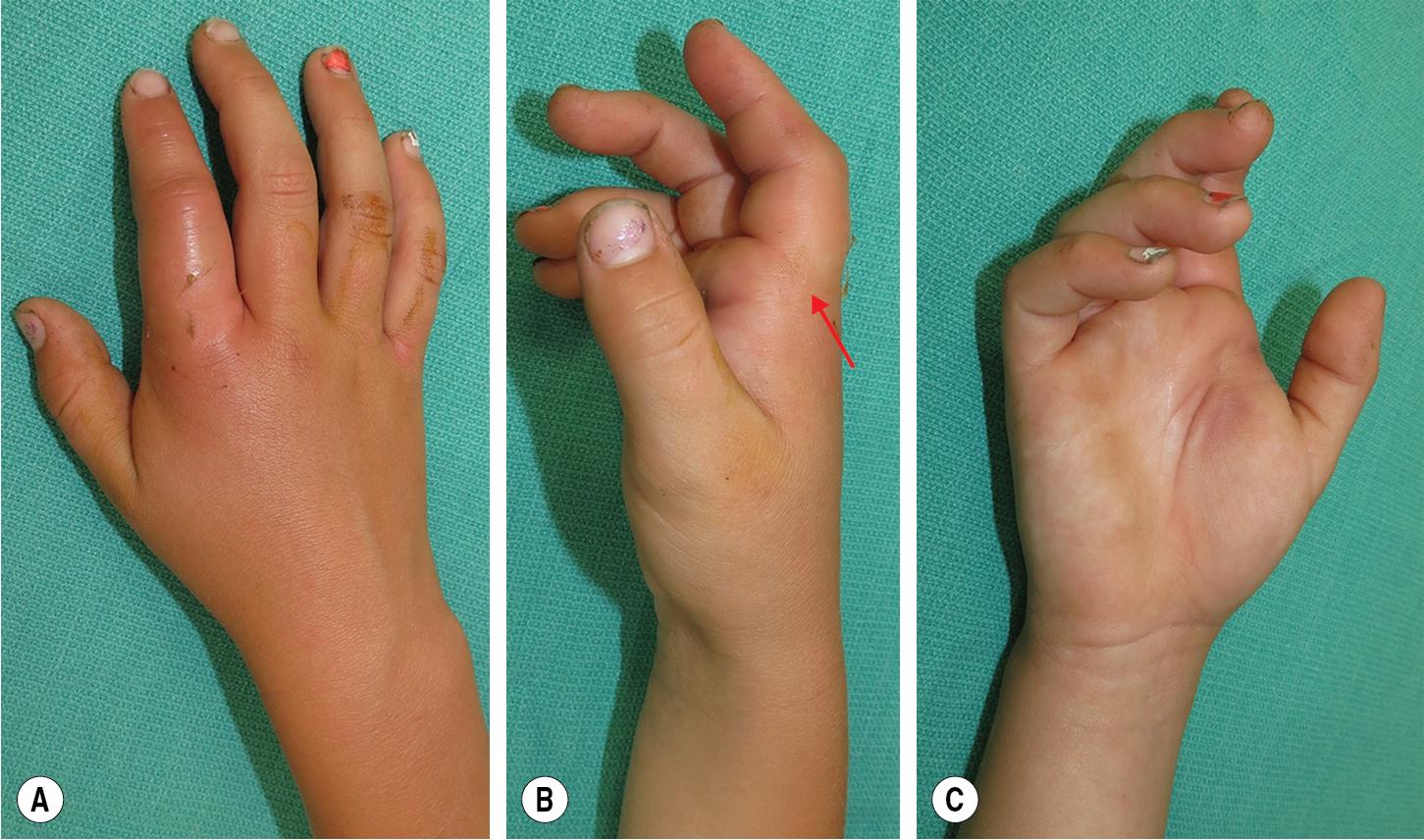 FIGURE 15.1, Complex dislocation of the index finger results in a swollen digit held in extension. Notice that there is no substantial metacarpophalangeal (MCP) joint hyperextension in complex dislocations ( red arrow ).