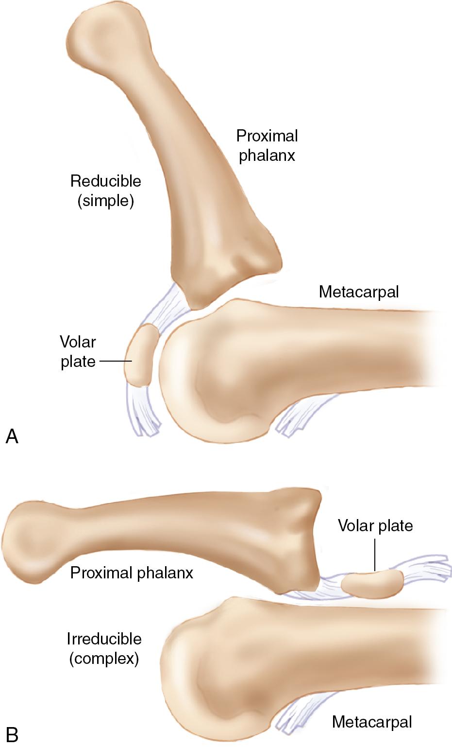 FIGURE 15.2, (A) With simple dislocations, the volar plate remains draped over the metacarpal head and the metacarpophalangeal (MCP) joint is held in substantial hyperextension. (B) In complex dislocations, the volar plate can be drawn entirely dorsally.