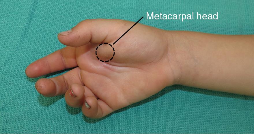 FIGURE 15.3, The head of the metacarpal can be seen and palpated just beneath the skin.