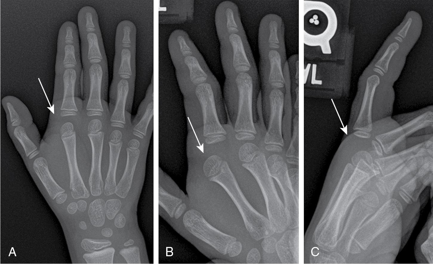 FIGURE 15.4, (A) Anteroposterior, (B) oblique, and (C) lateral views show the metacarpophalangeal (MCP) joint dislocation of the index finger ( white arrows ). The radiographs demonstrate increased joint space, loss of congruity, and subtle soft-tissue swelling.