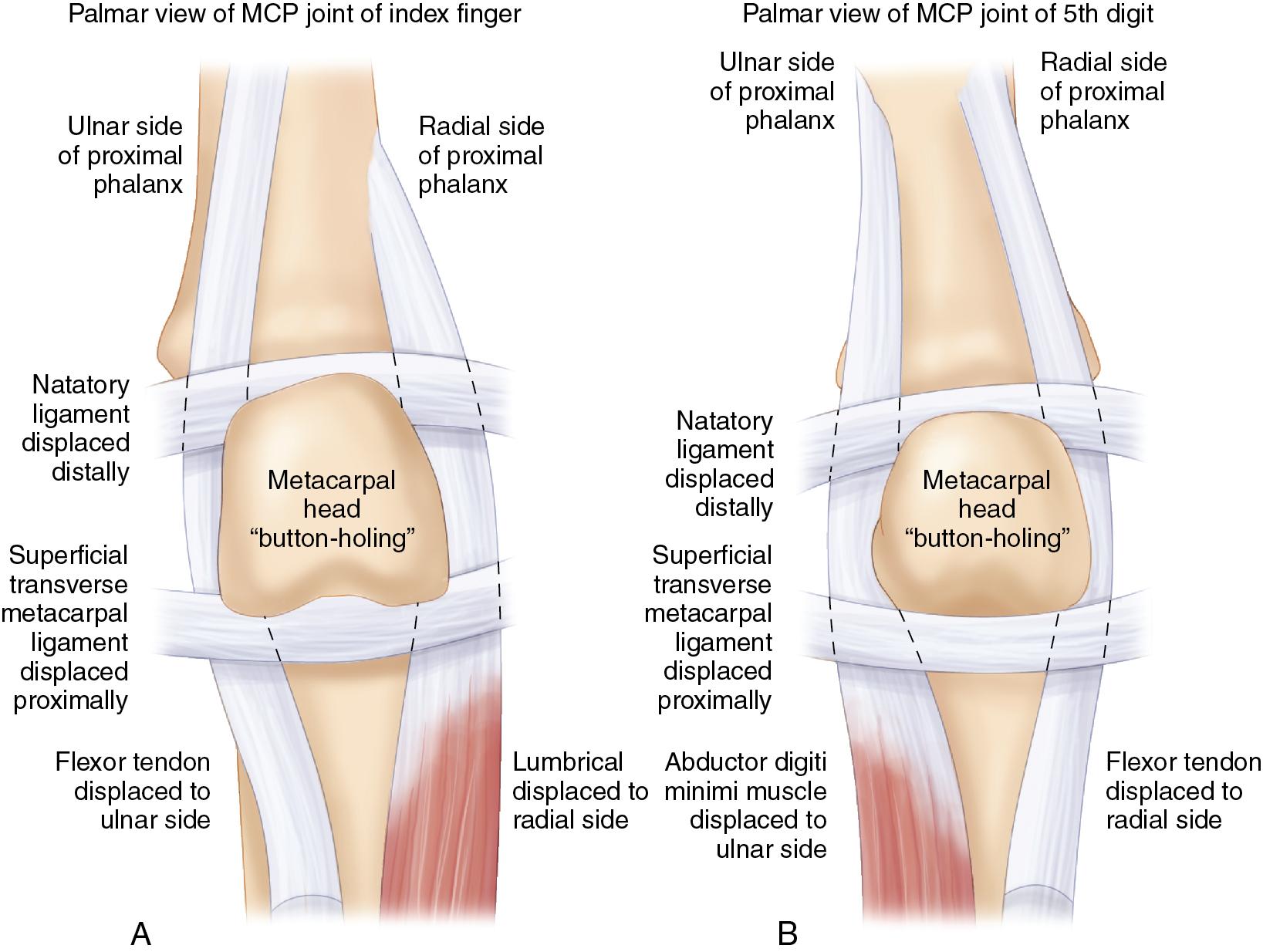 FIGURE 15.5, Artistic representation of an (A) index finger and (B) small finger metacarpophalangeal (MCP) joint dislocation with displacement of surrounding ligamentous and tendinous structures that form a so-called “noose” around the metacarpal head.