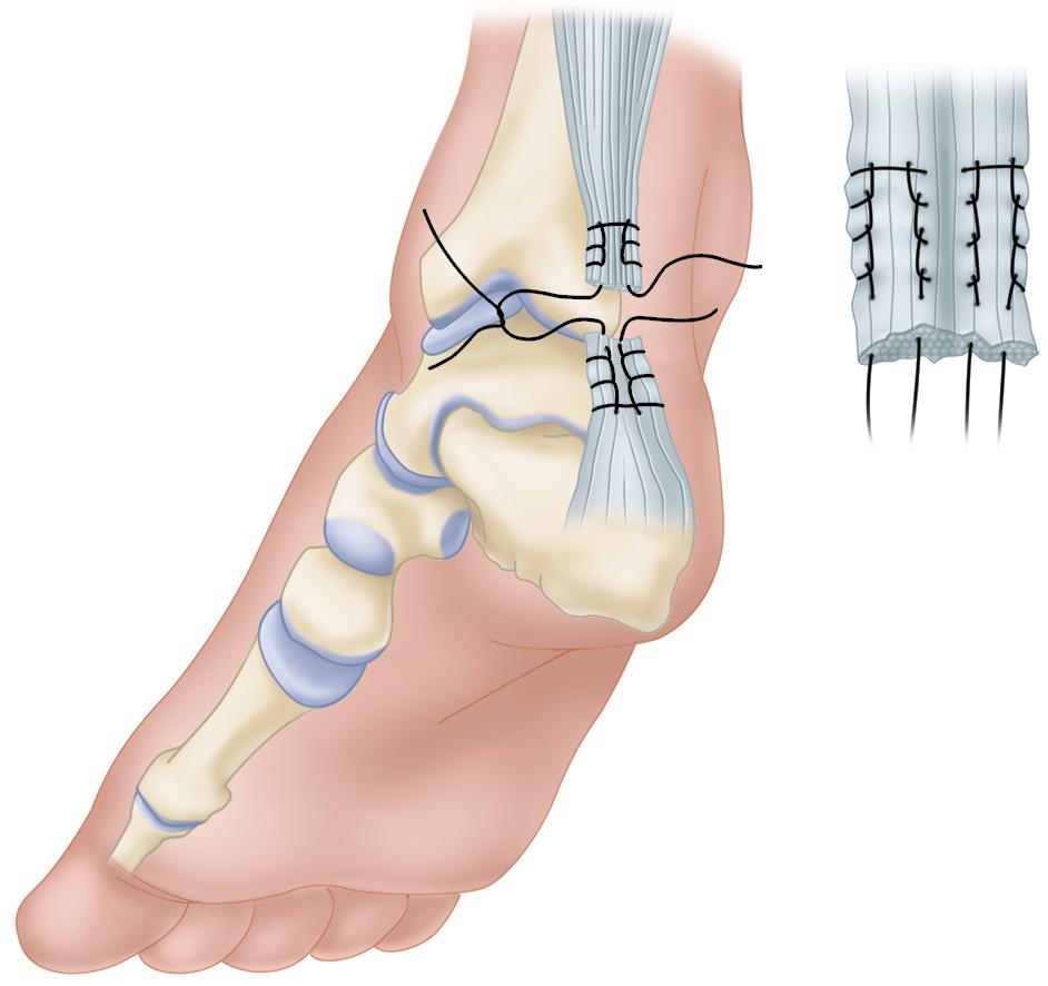 Figure 16.1, Krakow suture technique for Achilles tendon rupture .