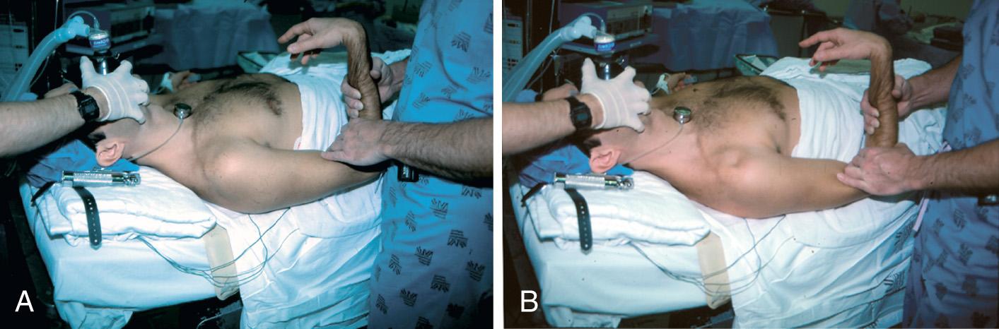 Fig. 13.2, (A) Shoulder before sulcus test. (B) Sulcus sign with longitudinal pull on the arm.