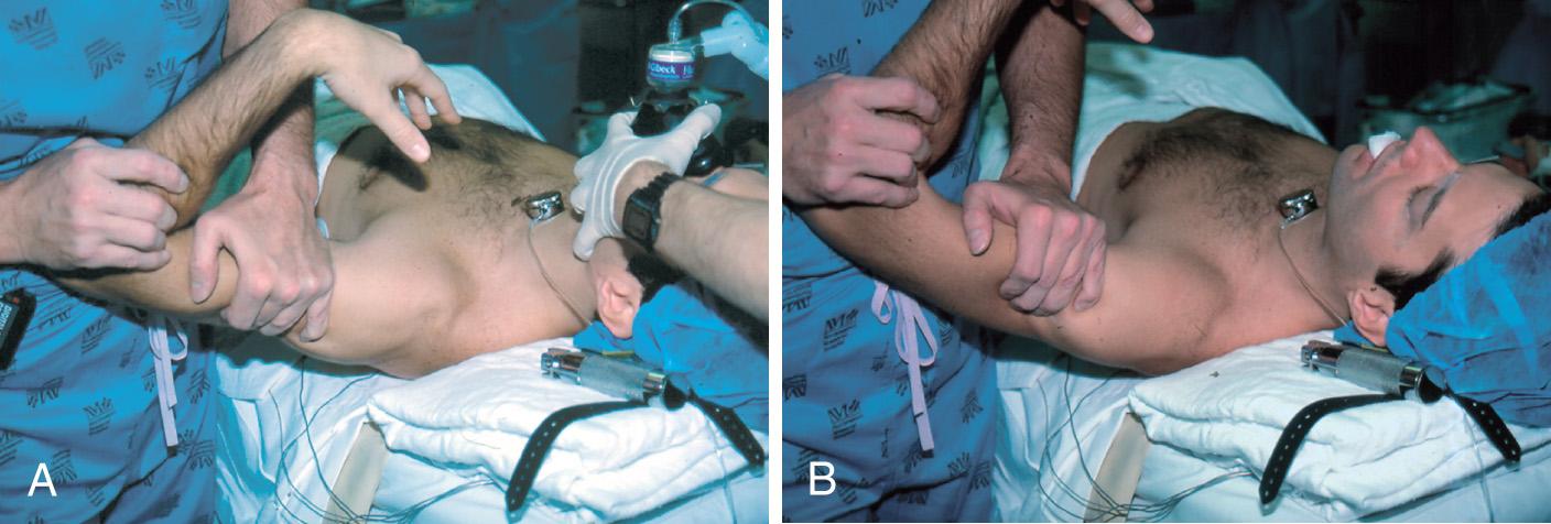 Fig. 13.3, (A) Load-shift test for anterior instability. (B) Load-shift test for posterior instability.
