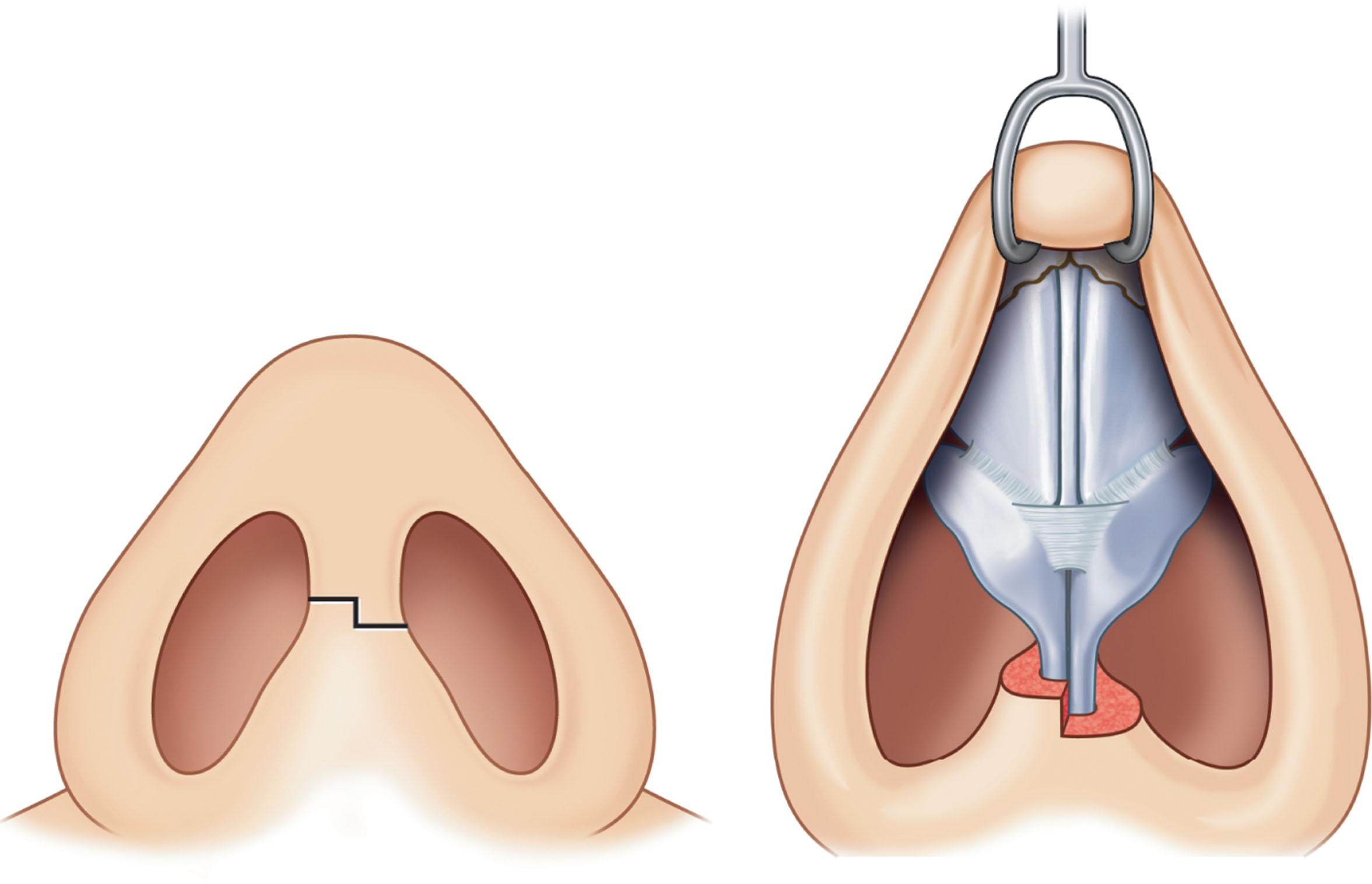 Figure 19.2, Transcolumellar stair-step incision.