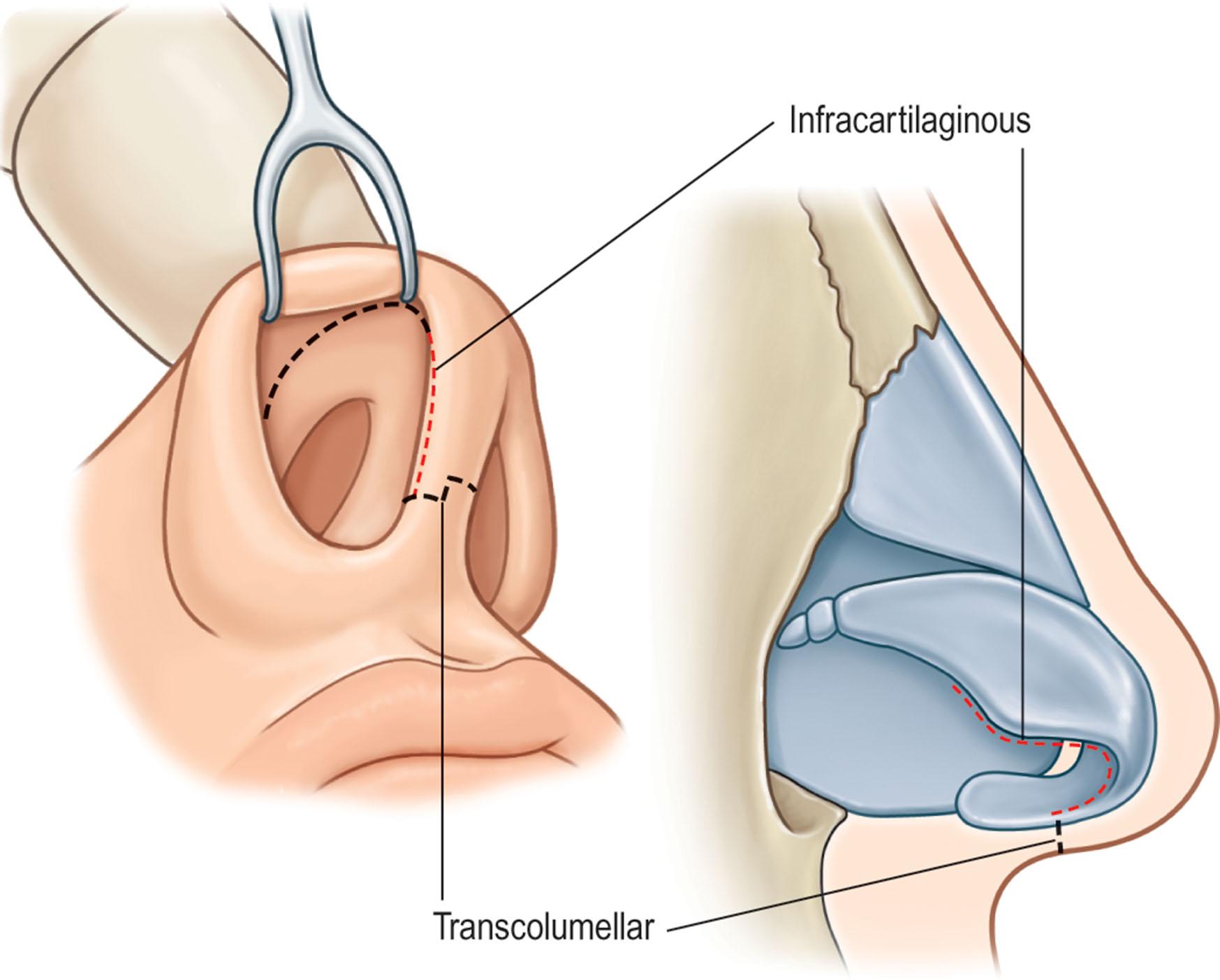 Figure 19.3, Transcolumellar stair-step incision with infracartilaginous extensions.