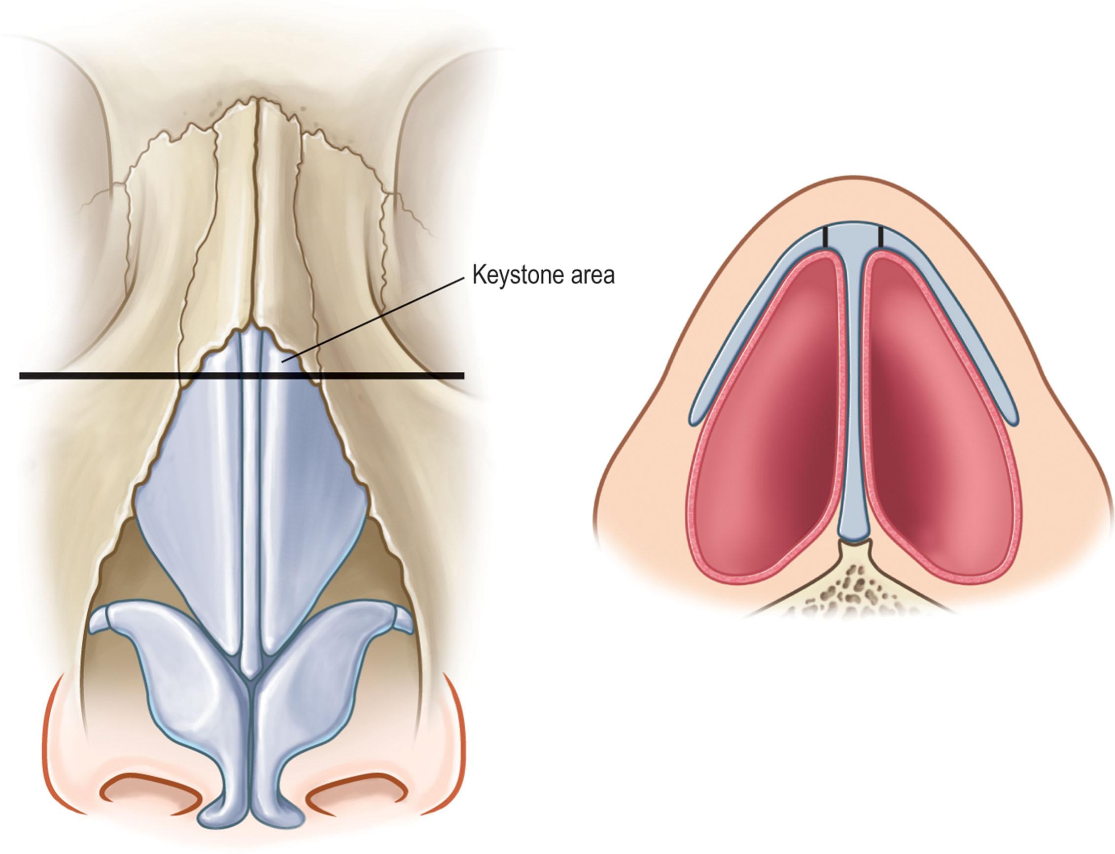 Figure 19.4, Nasal dorsum.