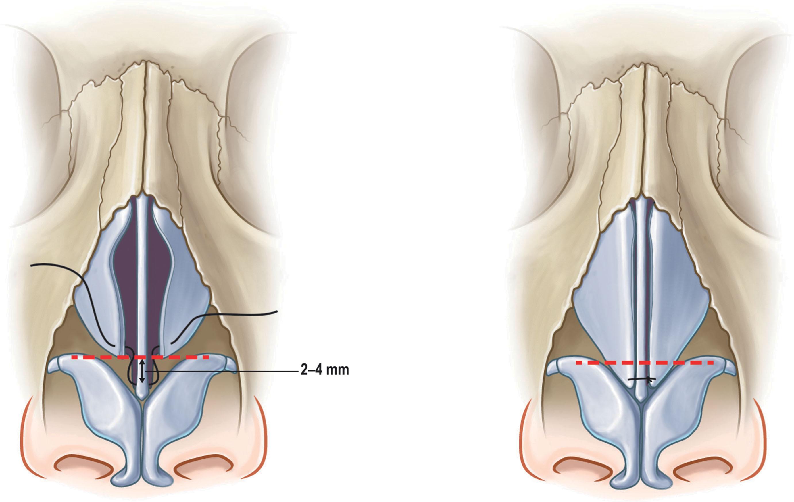 Figure 19.5, Upper lateral cartilage tension spanning sutures.