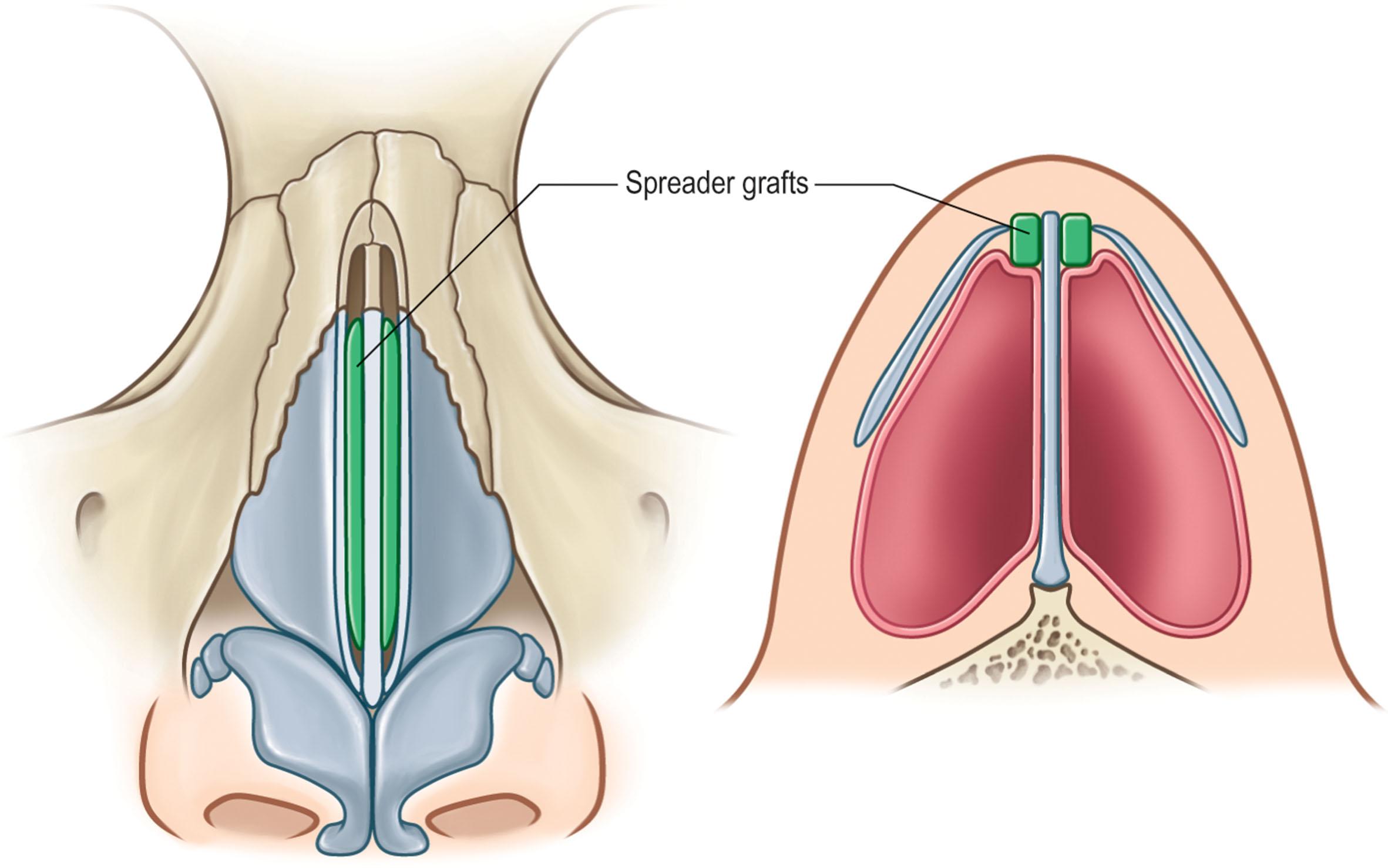 Figure 19.6, Dorsal spreader grafts.