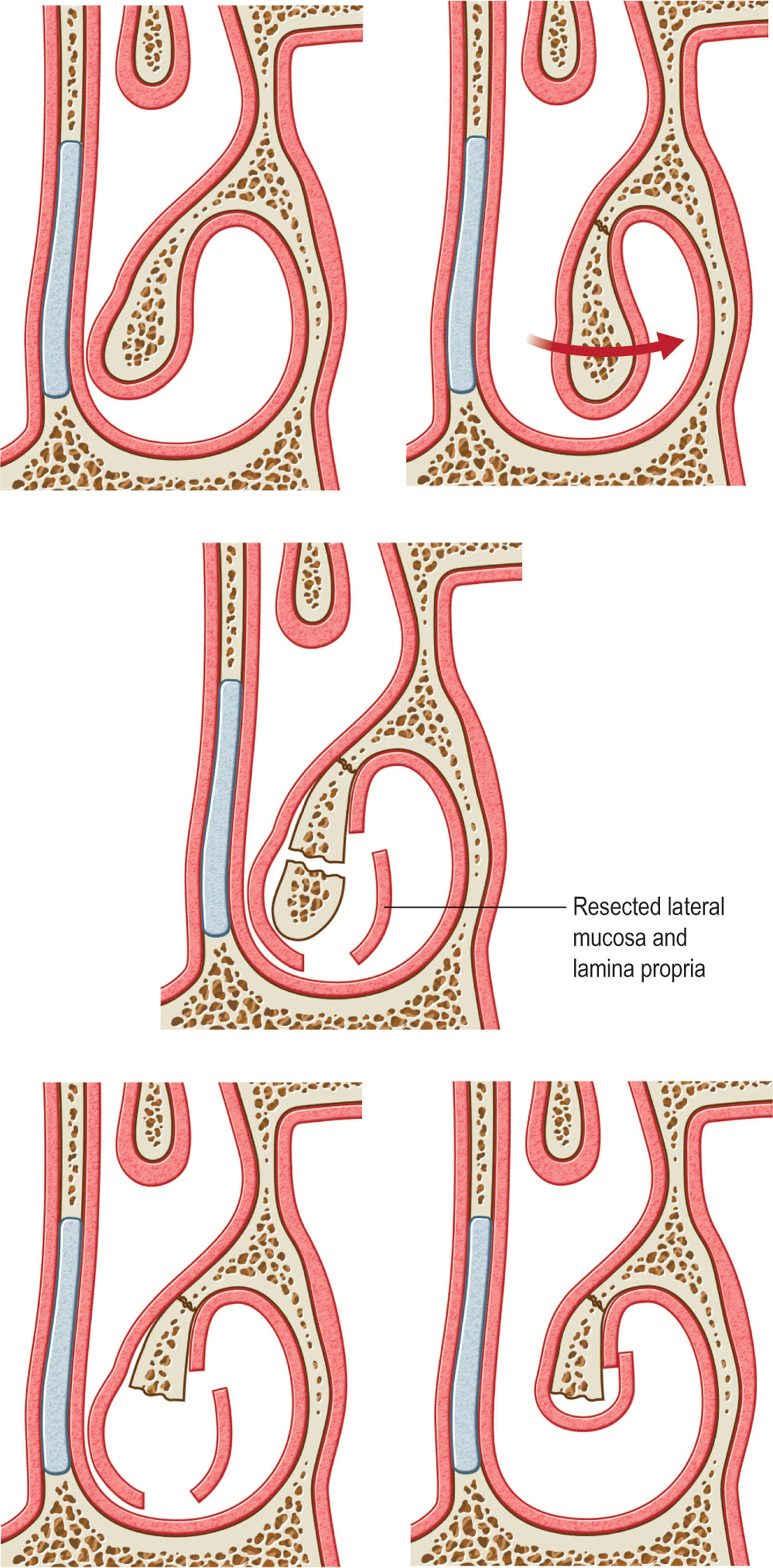 Figure 19.7, Inferior turbinate outfracture and submucous resection.