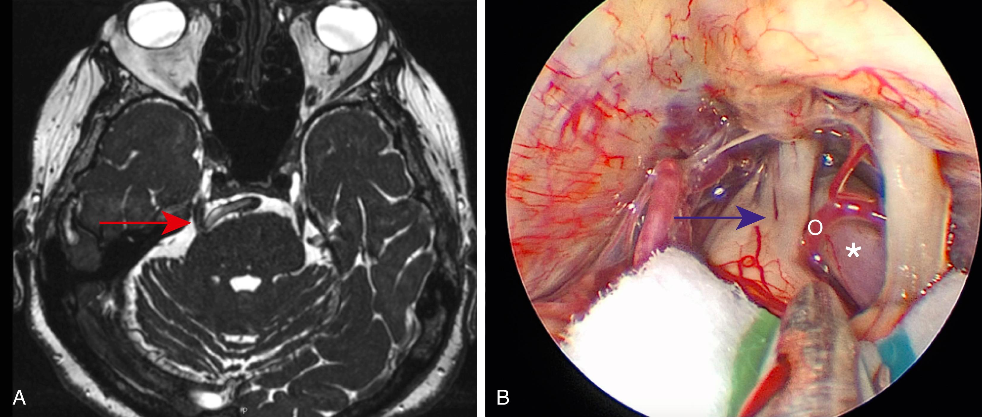 Fig. 39.1, Comparison of FIESTA (Fast Imaging Employing STeady-state Acquisition) MRI and intraoperative findings.