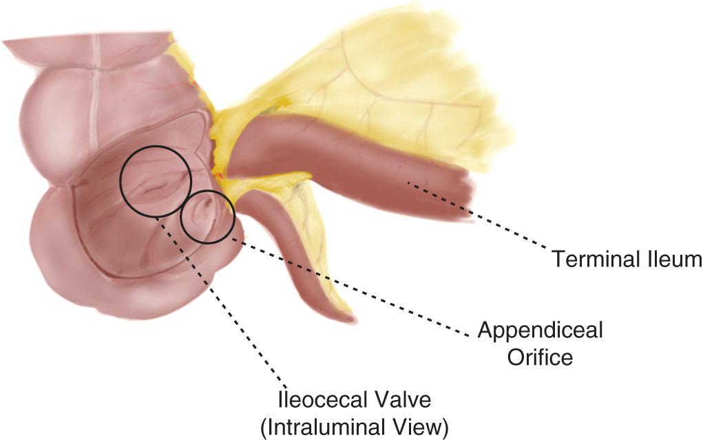 FIGURE 143.7, Anatomy of the ileocecal valve.