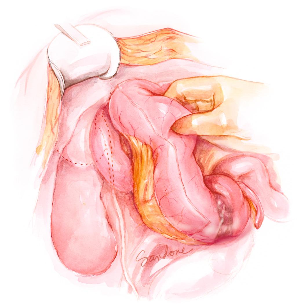 FIGURE 143.8, Following mobilization of the right colon mesentery, the retroperitoneal structures are easily visualized.