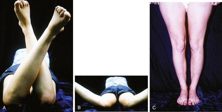 FIG 35-1, A to C, A classic case of increased femoral anteversion, external tibial torsion, and “squinting” patella requiring femoral rotational osteotomy and possible tibial rotational osteotomy, but proximal-distal realignment. A and B, Supine external-internal hip rotation abnormality. C, Standing rotational malalignment shows “squinting patella” and the “miserable malalignment syndrome.” D to J, Physical examination parameters are demonstrated. D, Lateral tibial patellar tendon attachment full extension. E and F, Q-angle increase with external tibial rotation 30 degrees of flexion. G, Q-angle returns to 0 with internal tibial rotation 30 degrees of flexion. H, Normal lateral glide 30 degrees of flexion. I and J, Manual medial glide 0 and 30 degrees of flexion. Palpation of all parapatellar soft tissues, fat pad, patellar tendon, and plica area is also performed.